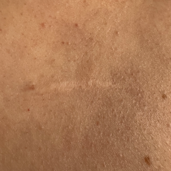 Scar reintegration